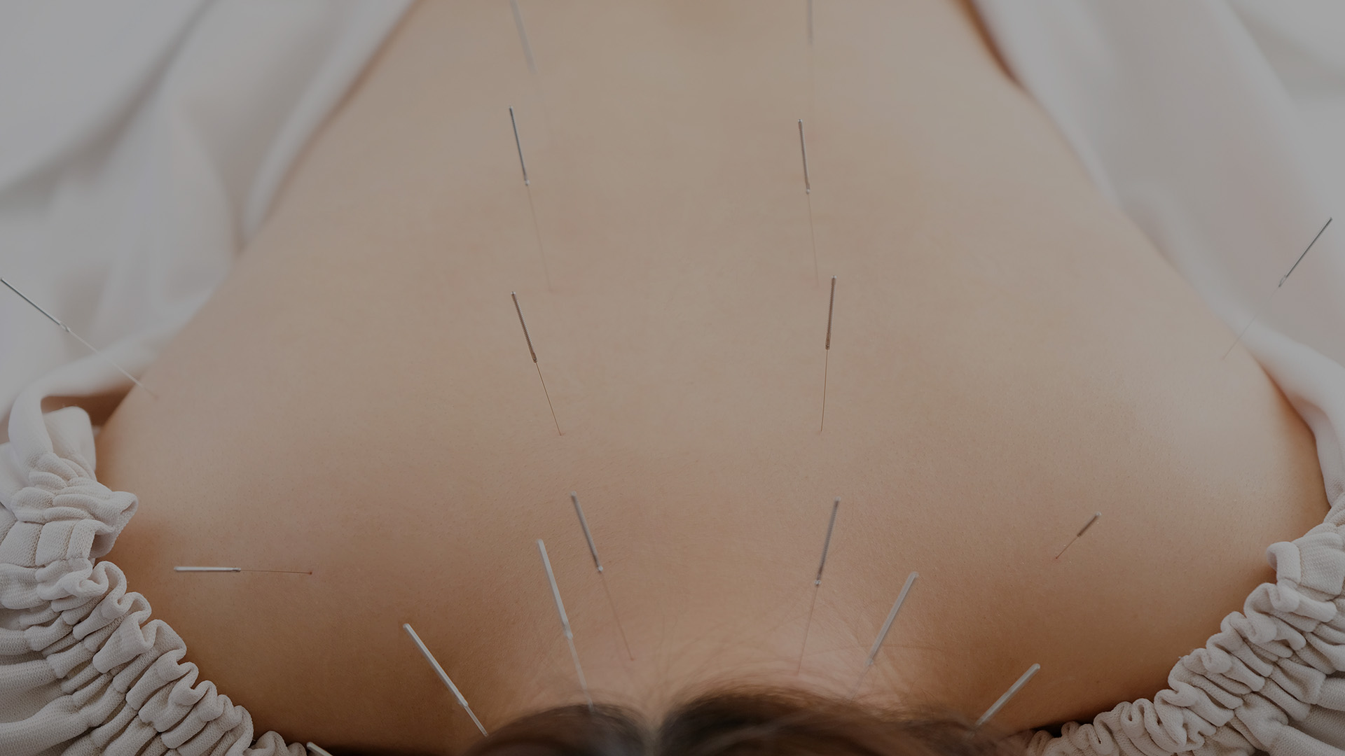 Acupuncture